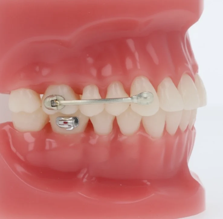 American Orthodontics Power Bar appliance shown on a dental model